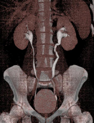 Normal CT Urogram - CTisus CT Scan