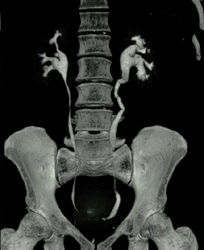 Normal CT Urogram - CTisus CT Scan