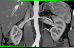 2 Left Renal Arteries With Prehilar Branching of the Upper Pole Artery - CTisus CT Scan