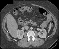 Renal Artery Aneurysm - CTisus CT Scan