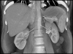 Renal Artery Aneurysm - CTisus CT Scan