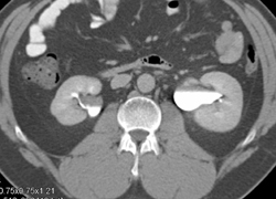 Obstruction Due to Distal Left Ureter Stone - CTisus CT Scan