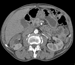 Acute Pyelonephritis in Right Kidney - CTisus CT Scan