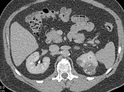 Renal Cell Carcinoma - CTisus CT Scan