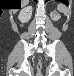 Renal Cell Carcinoma - CTisus CT Scan