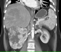 Renal Cell Carcinoma Causing Perfusion Changes and Tumor in the Liver - CTisus CT Scan