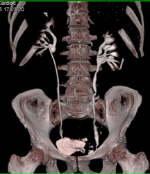 Bladder Cancer - CTisus CT Scan