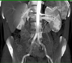 Retroaortic Renal Vein Shown With VRT and MIP Imaging - CTisus CT Scan