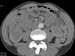 Transitional Cell Carcinoma in the Lower Pole of the Right Kidney - CTisus CT Scan