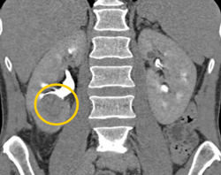 Transitional Cell Cancer (TCC) With Amputation of the Lower Pole Calyx - CTisus CT Scan