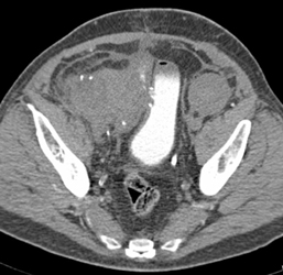 Acute Pancreatitis in Patient With Renal and Pancreatic Transplant - CTisus CT Scan