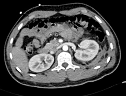 Renal Laceration and Bleed - CTisus CT Scan