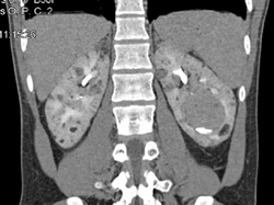 Von Hippel-Lindau syndrome (VHL) With Multiple Angiomyolipomas (AMLs) - CTisus CT Scan