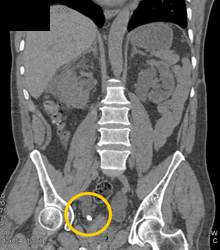 Stone in Distal Right Ureter - CTisus CT Scan