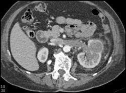 Transitional Cell Cancer (TCC) With Tumor Invading the Renal Vein - CTisus CT Scan