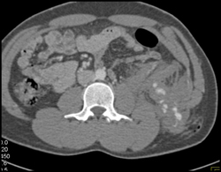 Renal Laceration and Bleed Along Stab Wound Track - CTisus CT Scan