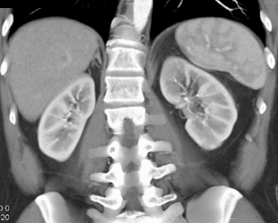 Acute Pyelonephritis - CTisus CT Scan