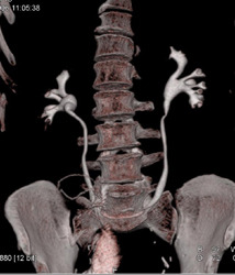 Ct Urogram - CTisus CT Scan