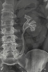 Ct Urogram - CTisus CT Scan