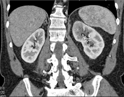 Acute Pyelonephritis - CTisus CT Scan