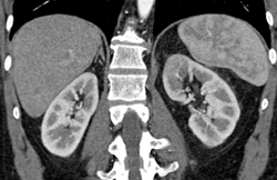 Acute Pyelonephritis - CTisus CT Scan