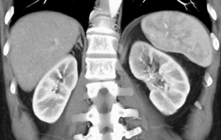 Acute Pyelonephritis - CTisus CT Scan