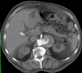 Renal Artery Aneurysm - CTisus CT Scan