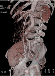 Renal Transplant With Artery to Iliac Artery - CTisus CT Scan