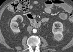 Renal Cell Carcinoma - CTisus CT Scan