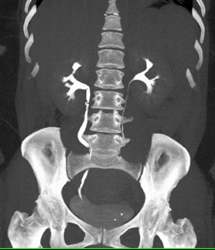 Stone Just Outside of Right Ureter - CTisus CT Scan