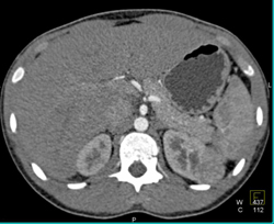 3 Cm Left Renal Cell Carcinoma (RCC) - CTisus CT Scan