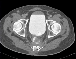 Ct Cystogram With Leak From the Bladder to the Rectum - CTisus CT Scan