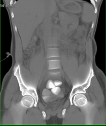 Large Bladder Calculi - CTisus CT Scan