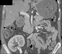 Pelvic Kidney With Stent - CTisus CT Scan