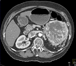 Hypervascular Renal Cell Carcinoma Invades the Renal Vein - CTisus CT Scan