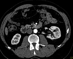 3 Cm Renal Cell Carcinoma (RCC) - CTisus CT Scan