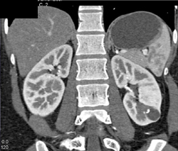 Renal Cyst With Calcification - CTisus CT Scan