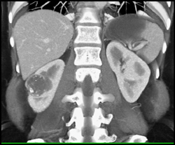 Cystic Renal Cell Carcinoma - CTisus CT Scan