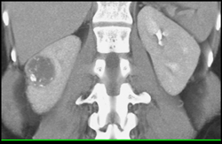 Cystic Renal Cell Carcinoma - CTisus CT Scan