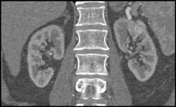 1 Cm Vascular Renal Cell Carcinoma - CTisus CT Scan