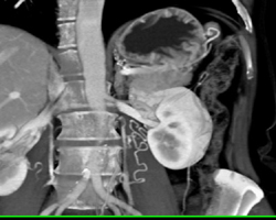 Collateral Vessels Near Renal Hilum - CTisus CT Scan