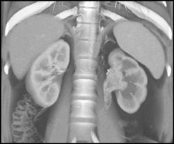 Transition Cell Carcinoma of the Left Kidney and Ureter - CTisus CT Scan