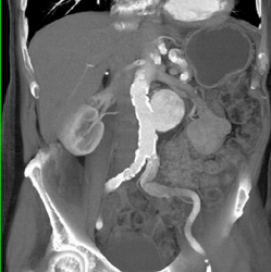 Renal Artery Aneurysm - CTisus CT Scan