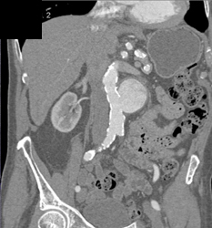 Renal Artery Aneurysm - CTisus CT Scan