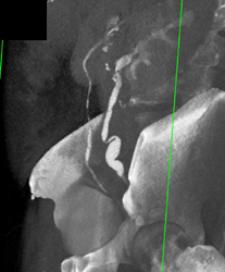 Tortuous Ureter With Focal Kink - CTisus CT Scan