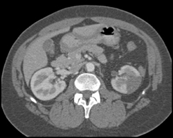 Renal Infarction - CTisus CT Scan