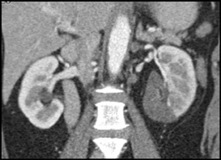 Renal Infarction - CTisus CT Scan