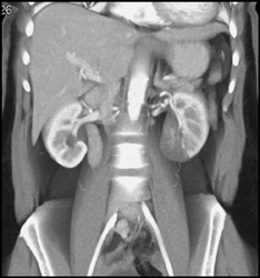 Renal Infarction - CTisus CT Scan