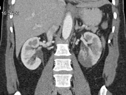 Renal Infarction - CTisus CT Scan