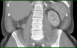 Hypervascular Right Renal Cell Carcinoma (RCC) With Peri Renal Extension - CTisus CT Scan